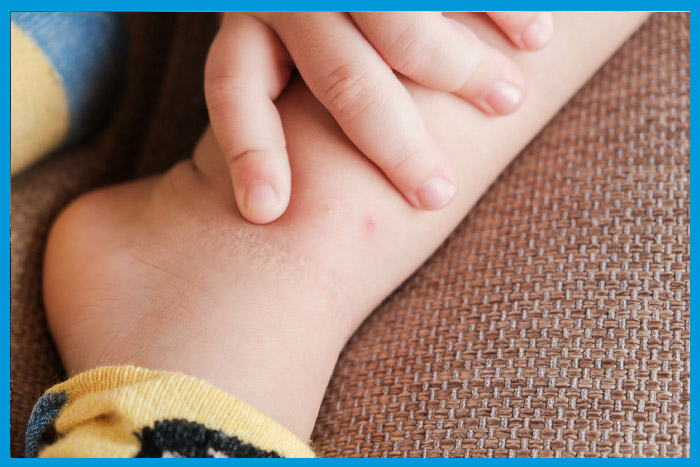 Piqûre de punaises de lit sur le pied d'un nourrisson
