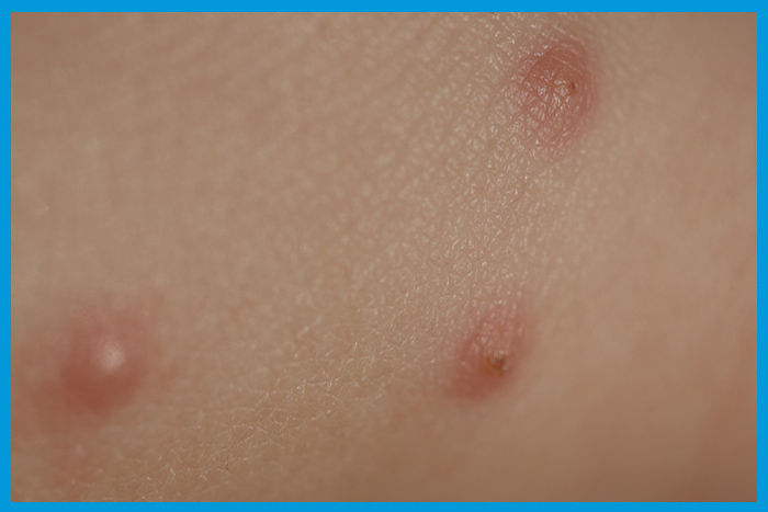 Trois boutons de punaises de lit alignés sur un bras