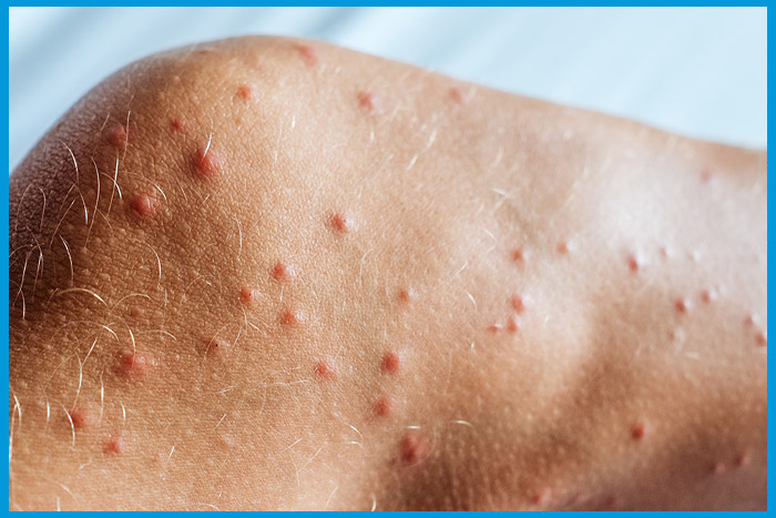 Infestation de piqûres de punaises de lit sur les jambes