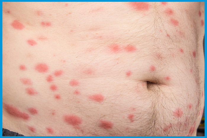 Réactions cutanées causées par des piqûres de punaises de lit sur le ventre