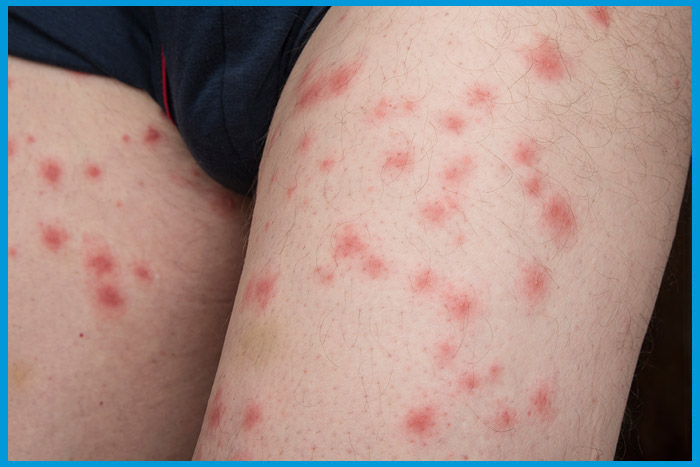 Réaction cutanée due aux piqûres de punaises de lit sur la peau