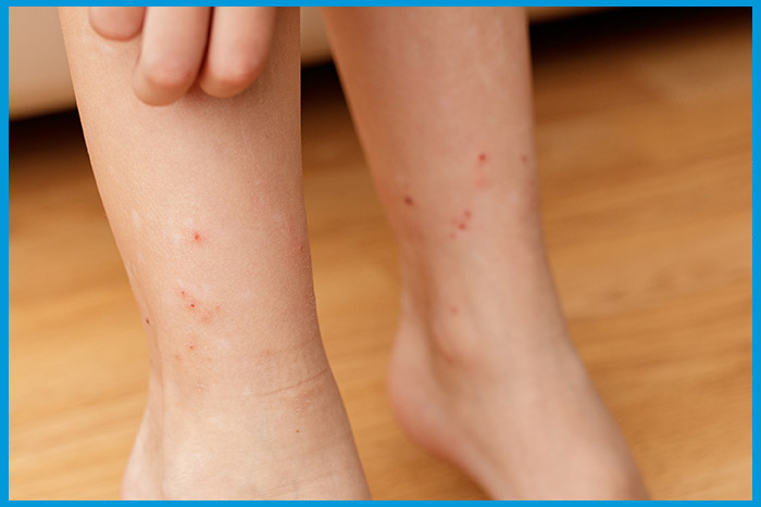 Jambe montrant des marques de piqûres de punaises de lit