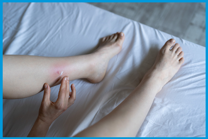 Application de crème sur les boutons causés par les punaises de lit.