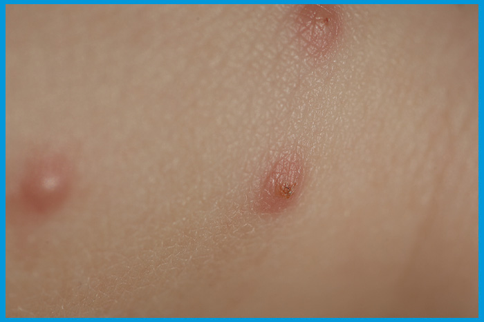 Piqûres de punaises de lit alignées en groupes de trois