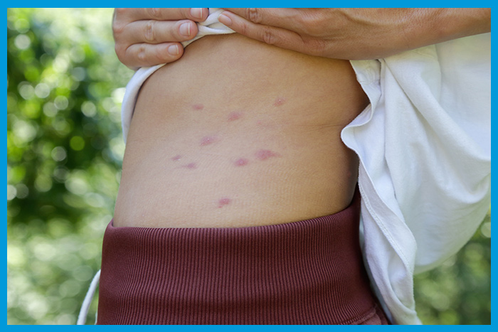 Piqûres de punaises de lit localisées sur l'abdomen