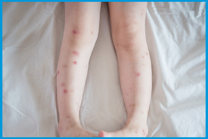 Piqûres rouges de punaises de lit sur les jambes d'un enfant