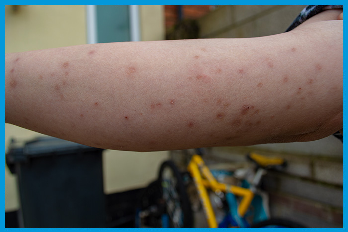 Bras infesté de piqûres de punaises de lit