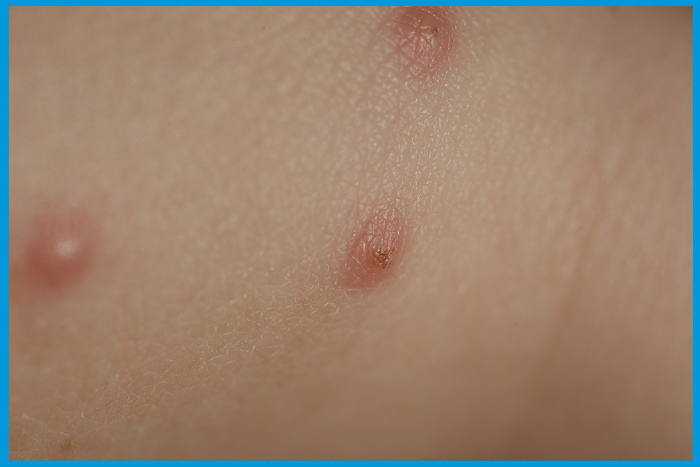 Gros plan sur trois piqûres de punaises de lit