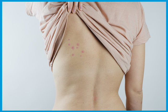 Piqûre de punaises de lit sur le dos.