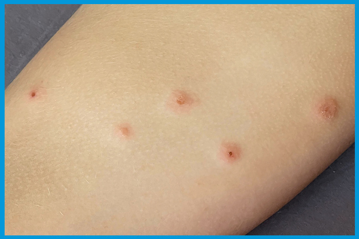 Gros plan sur des piqûres de punaises de lit