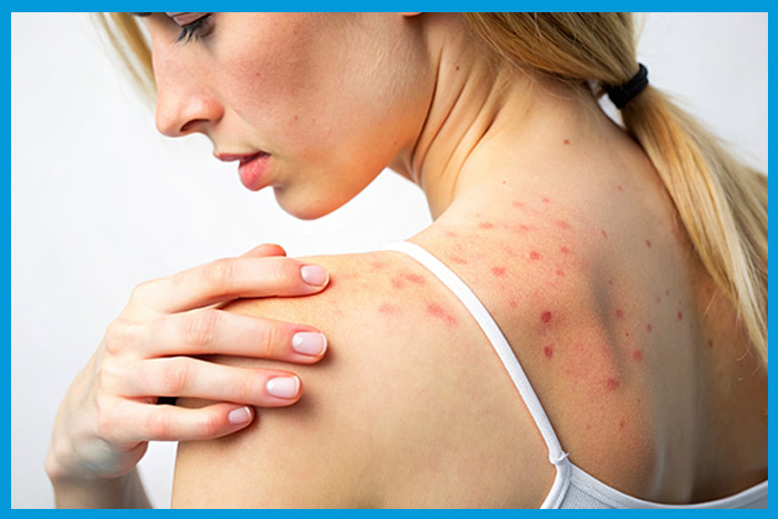 Bouton dû à une allergie sur le dos d'une femme.