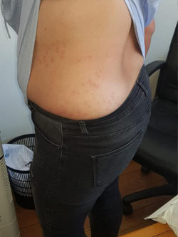 Piqures de punaises de lit sur le dos