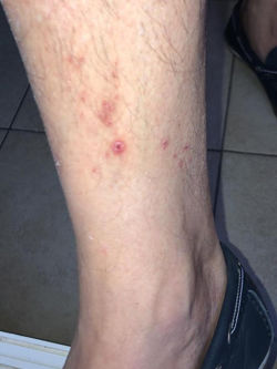 Piqures de puces de lit sur les jambes