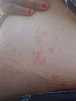 Piqure de punaise de lit sur le ventre
