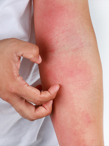 Piqures d'acariens démangeaisons sur le bras