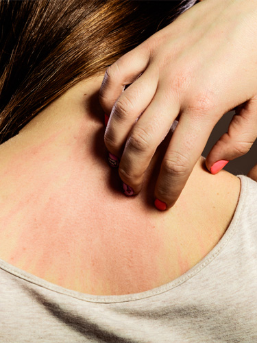 Piqure d'acarien présence de rougeurs sur le dos