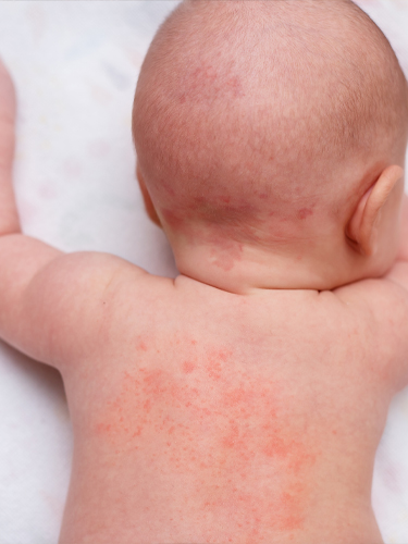 Piqures d'acariens sur le dos d'un bébé