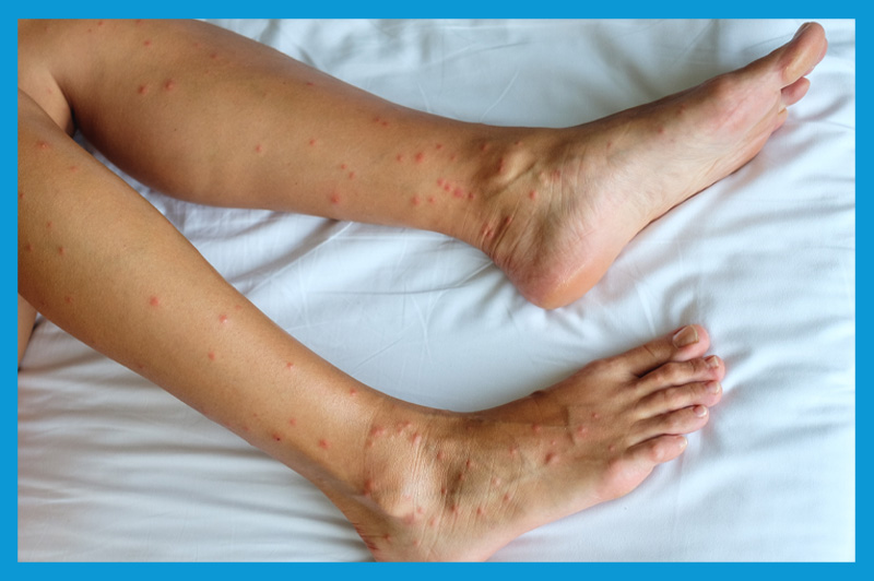 Les symptômes de la piqûre de punaise de lit