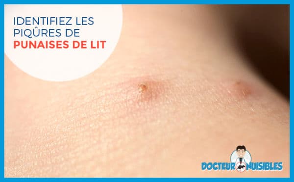 Identifiez les piqure de punaises de lit